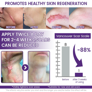 Timilk REGENSCAR Stem Cell Scar Gel provides a triple-action formula to help lock-in moisture - 20g