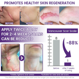 Timilk REGENSCAR Stem Cell Scar Gel provides a triple-action formula to help lock-in moisture - 20g